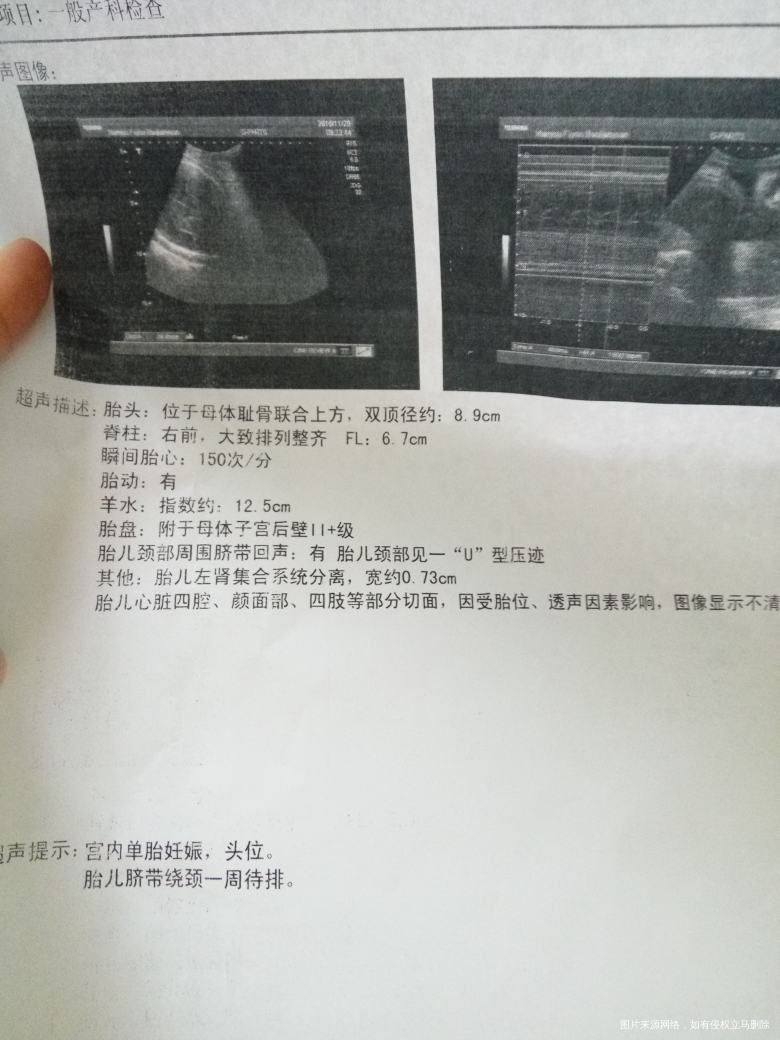 37周的B超单,医生帮我看看