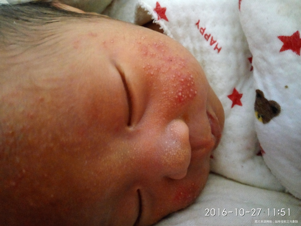 宝贝十二天了,脸上起湿疹了