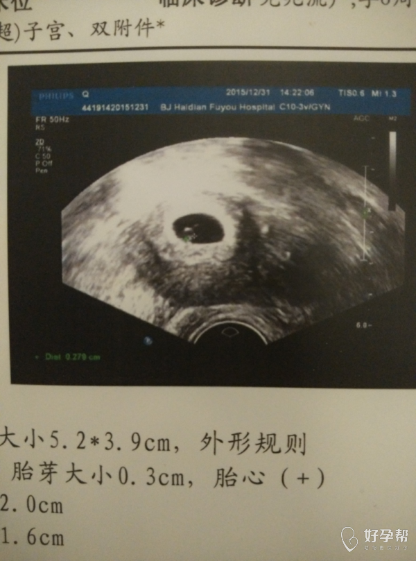 孕期46天,见胚心胚芽喽…有接的不?