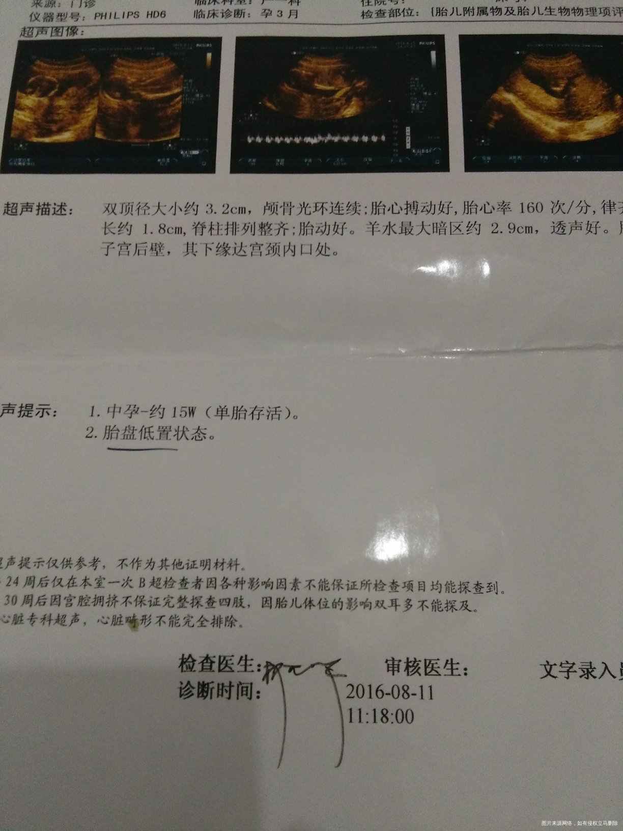 【我的孕期分享】不省心的二胎宝贝