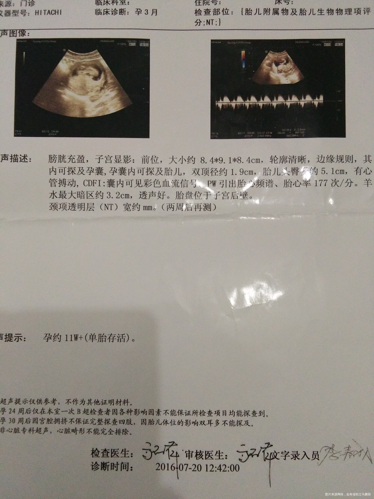 【我的孕期分享】不省心的二胎宝贝