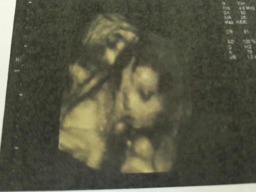 【备孕解压】好心情才能“好孕”