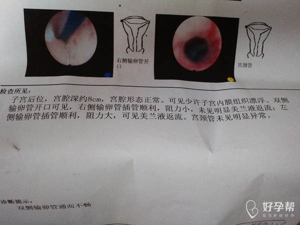昨天做了宫腔镜插管手术