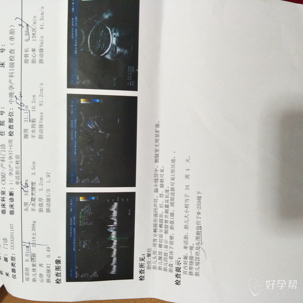 胎儿颅骨成椭圆形强回声是啥意思呀?