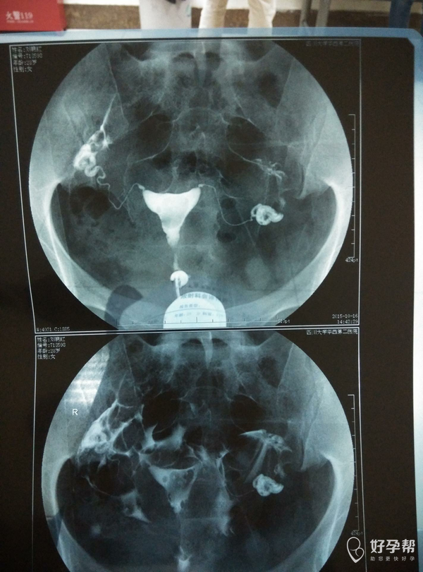 回忆我的输卵管造影经历,希望能帮到姐妹们