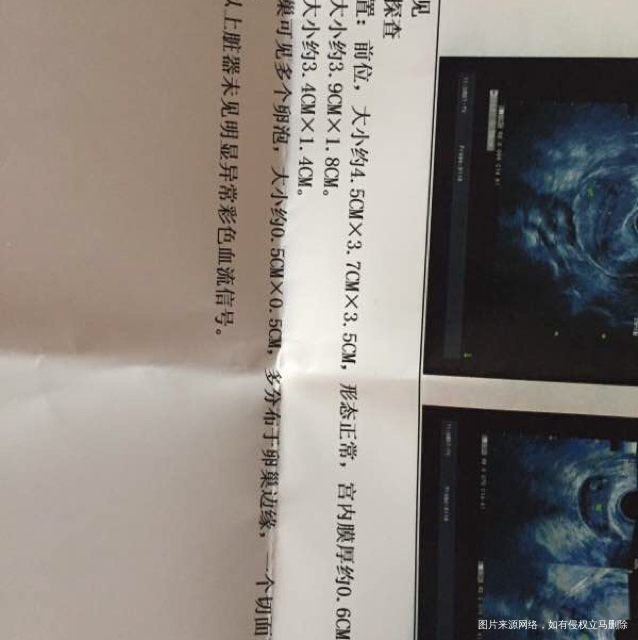 多囊卵巢综合症,大家一起来出招!