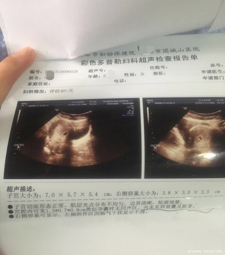 【好孕经验】多囊+输卵管不通+盆腔炎+宫糜