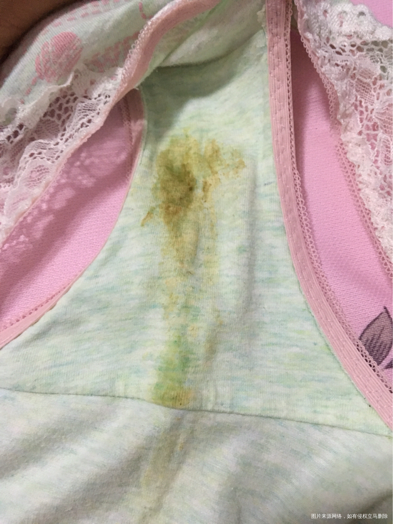 白带怎么这么黄,是不是炎症???