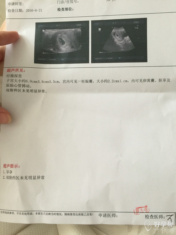 孕49天,做b超已经看到胎心胎芽啦