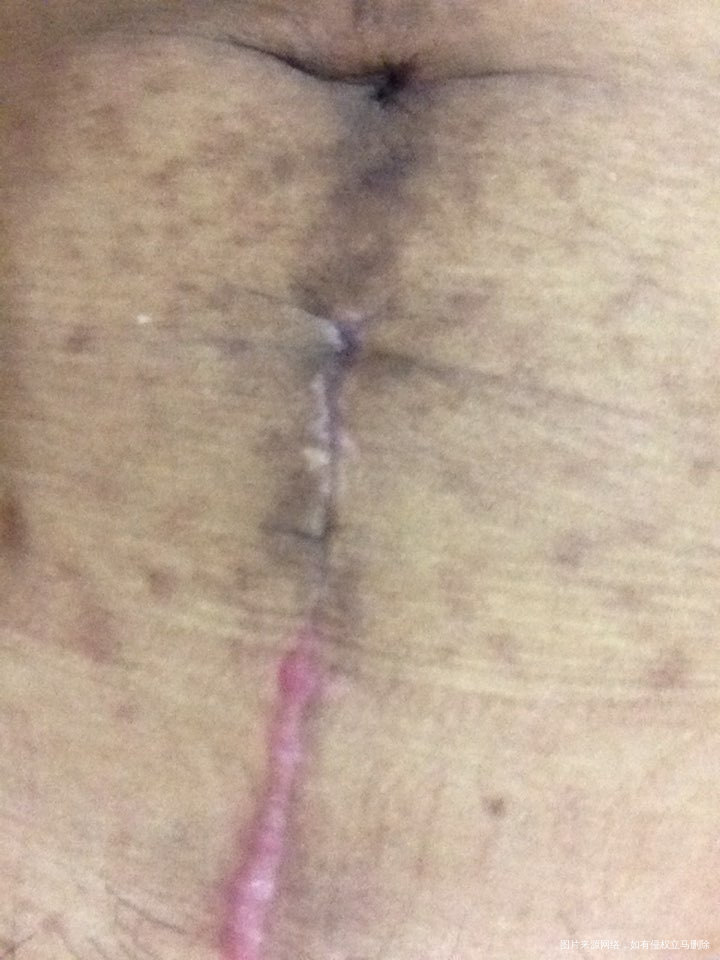 刨腹产的疤为什么上下不一样还有个坑?