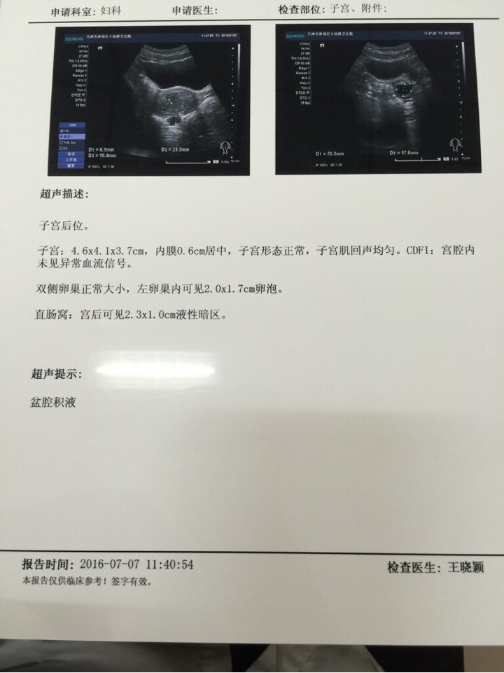 我这个盆腔积液影响怀孕吗?