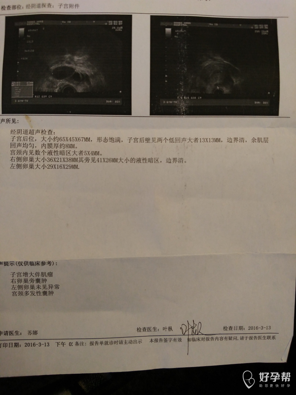 患有巧克力囊肿,子宫肌瘤,还能怀孕吗?