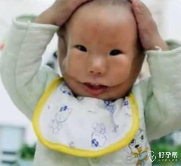 生个健康完美的宝宝最重要～ 14个月的湖南男孩康康,患有天生横向面裂