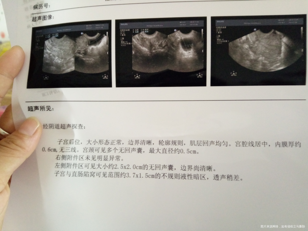 纠结，是在北京做宫腹腔镜呢，还是回老家去做试管呢