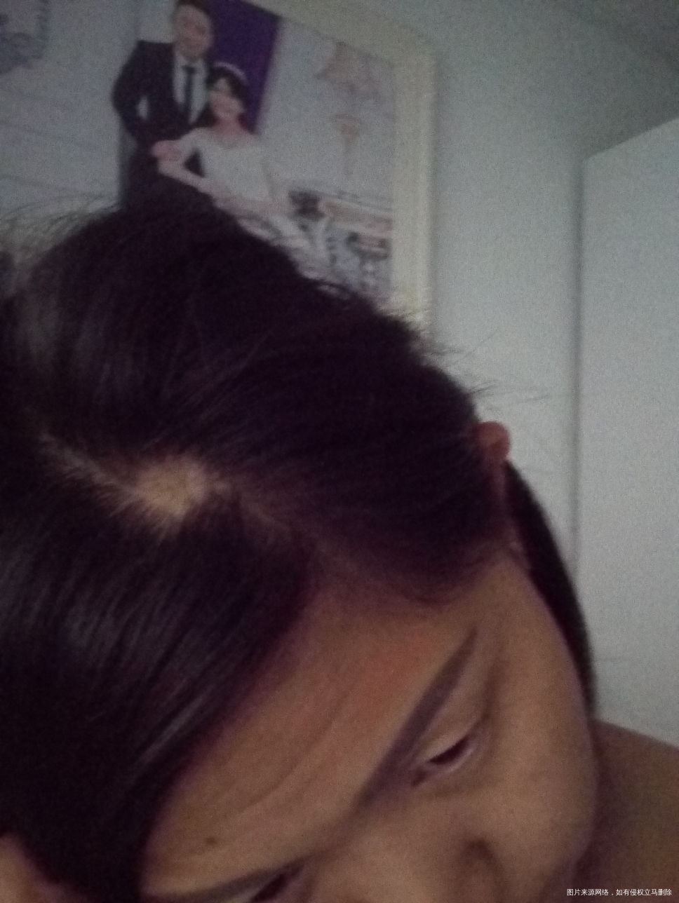 亲爱的们,掉头发很厉害是怎么回事呢。帮帮我。