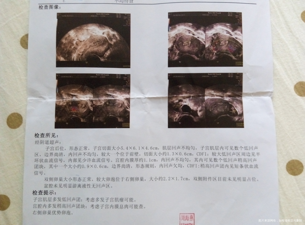 子宫肌瘤和子宫息肉能同时手术拿掉吗,复发率有多高