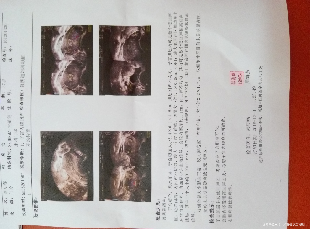 子宫肌瘤和子宫息肉能同时做手术吗