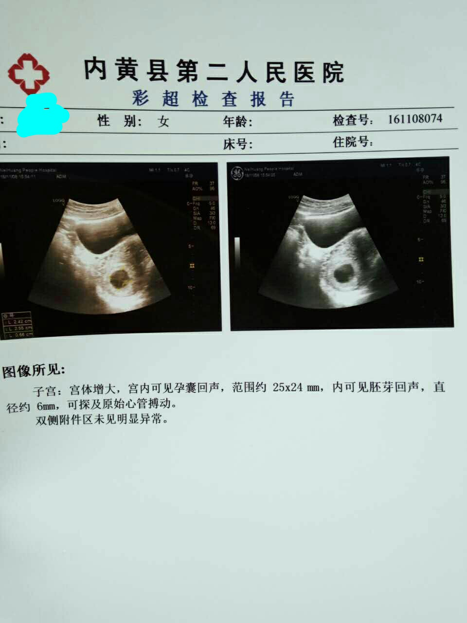 怀孕45天开始见红检查医生说没事