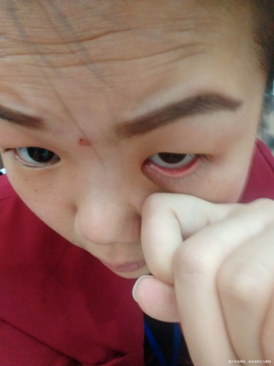 烦死了,眼角里长了个东西!怎么会长这个呢?