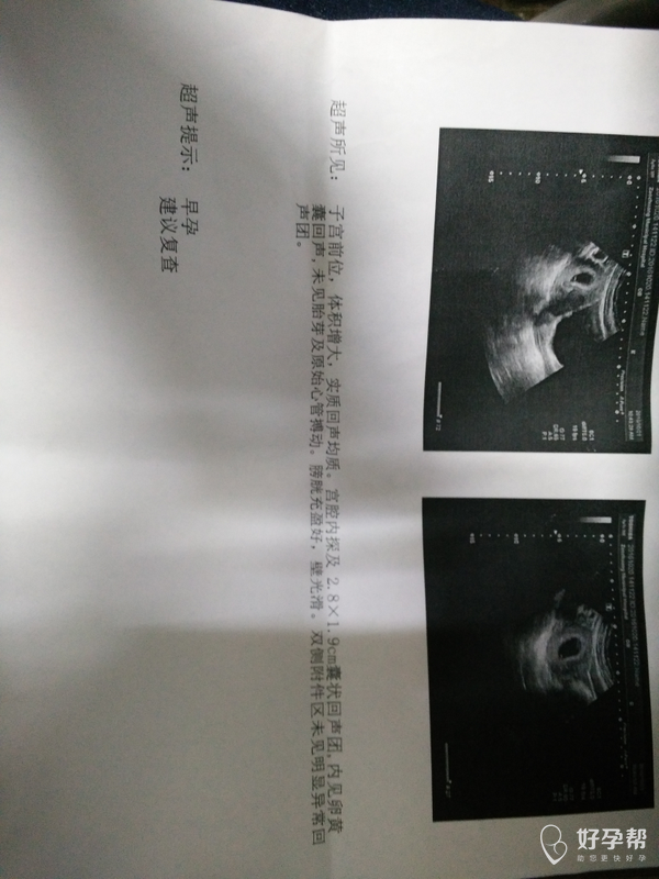 早孕45天,b超未见胎心胎芽,正常吗,求心安