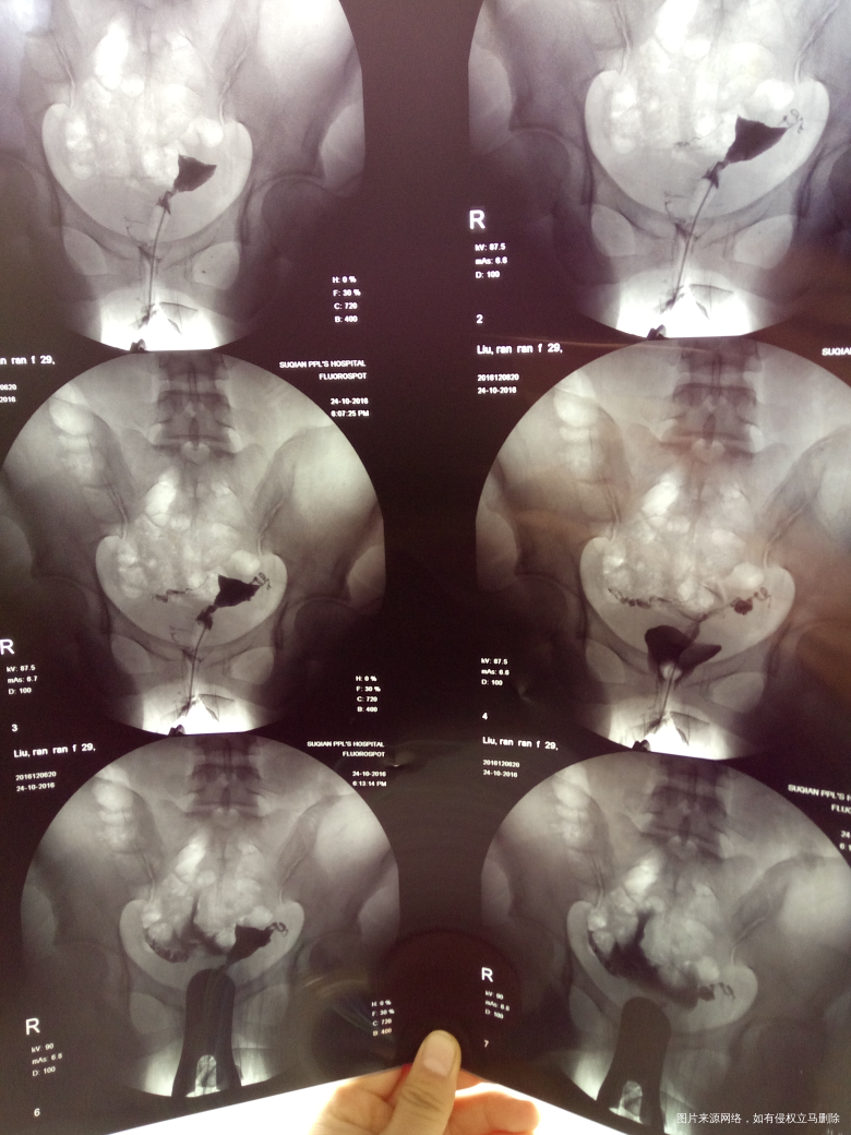 造影回来说是输卵管不通,麻烦医生给看一下