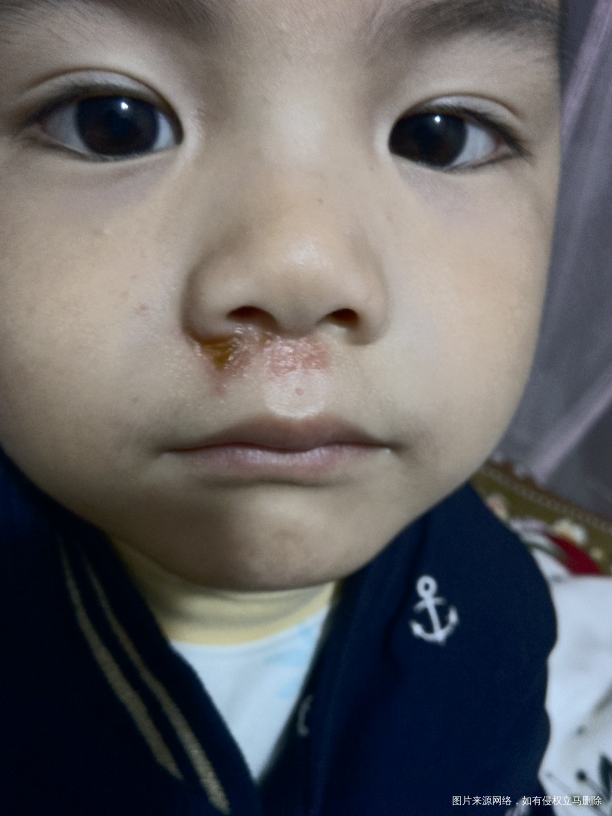 我大宝鼻子下面烂了怎么办😱