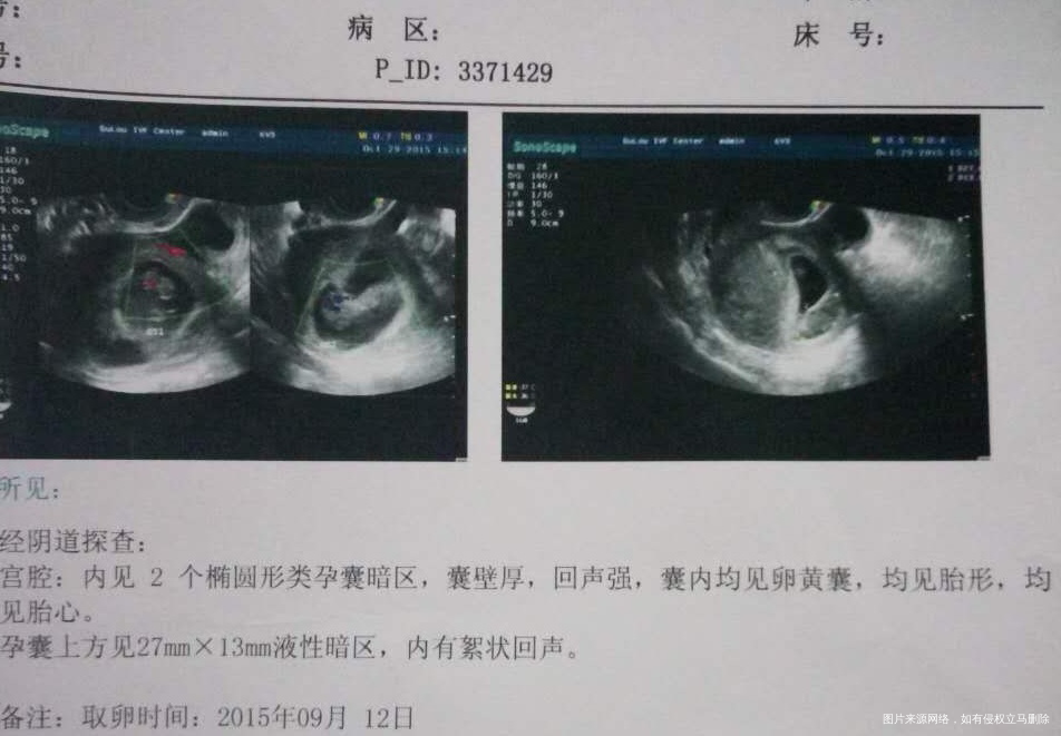 给各位报喜啦!试管妈妈。