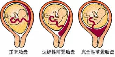 边缘性前置胎盘的诊疗