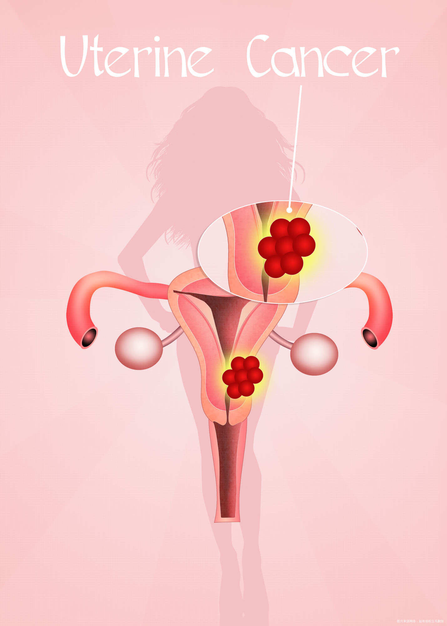 子宮內膜移位懷孕有影響嗎