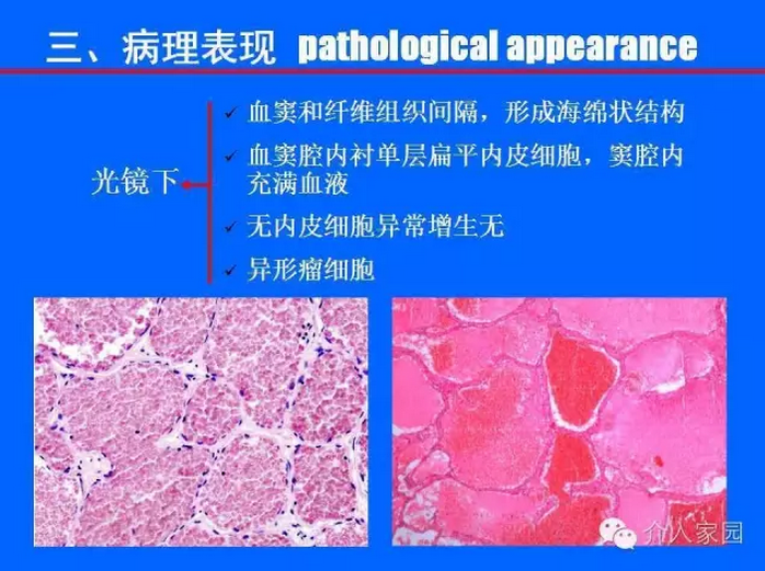 肝脏海绵状血管瘤-基础与介入 (转载)