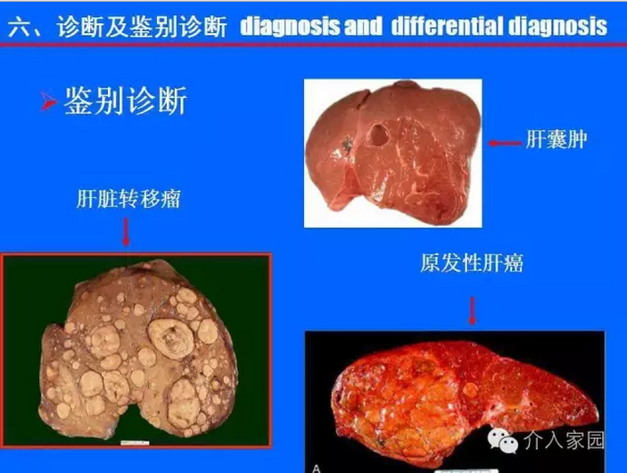 肝脏海绵状血管瘤-基础与介入 (转载)