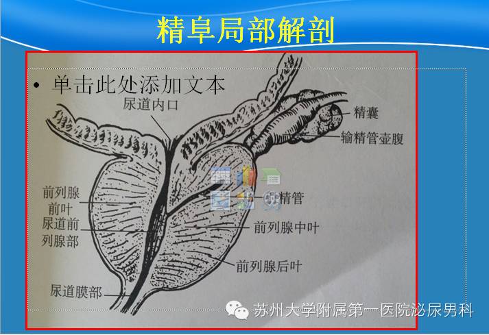 经尿道精阜后唇切除术治疗射精管梗阻的前瞻性探讨(原创)