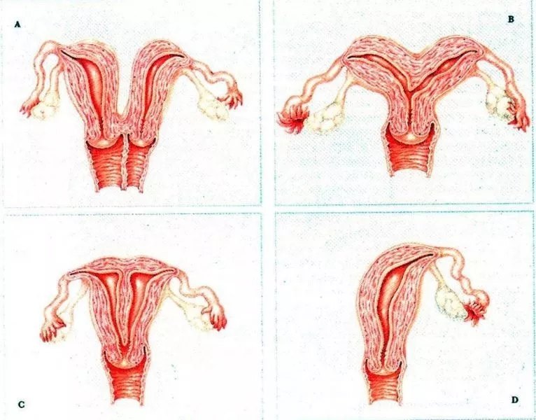 唐医生科普什么是残角子宫原创