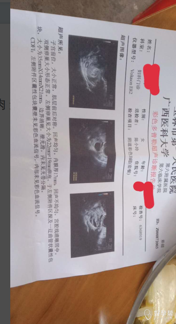 
我高龄44岁,从2016到2019年做试管