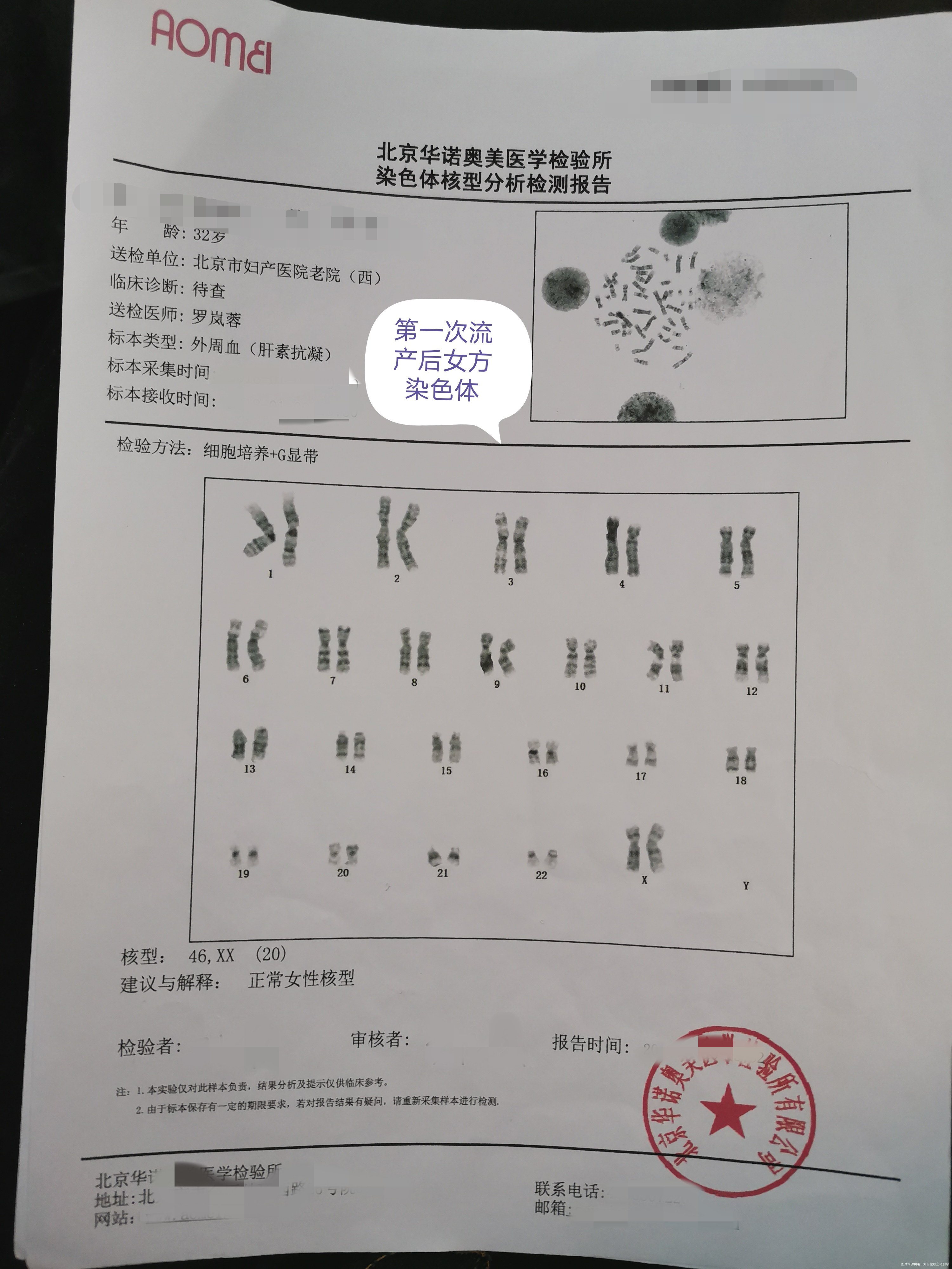 夫妻染色体正常 胚染有问题,45x。一次葡萄