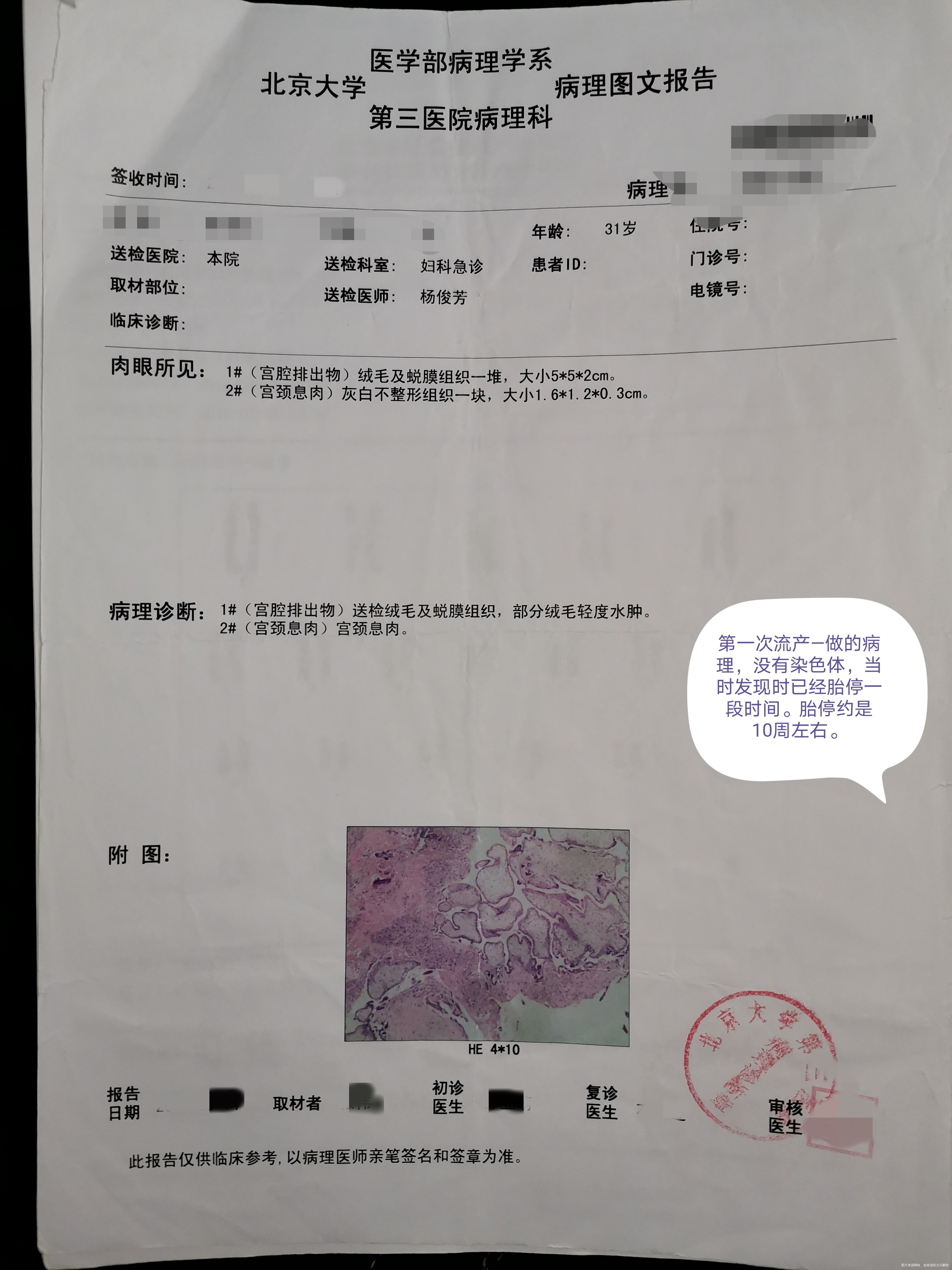 夫妻染色体正常 胚染有问题,45x。一次葡萄