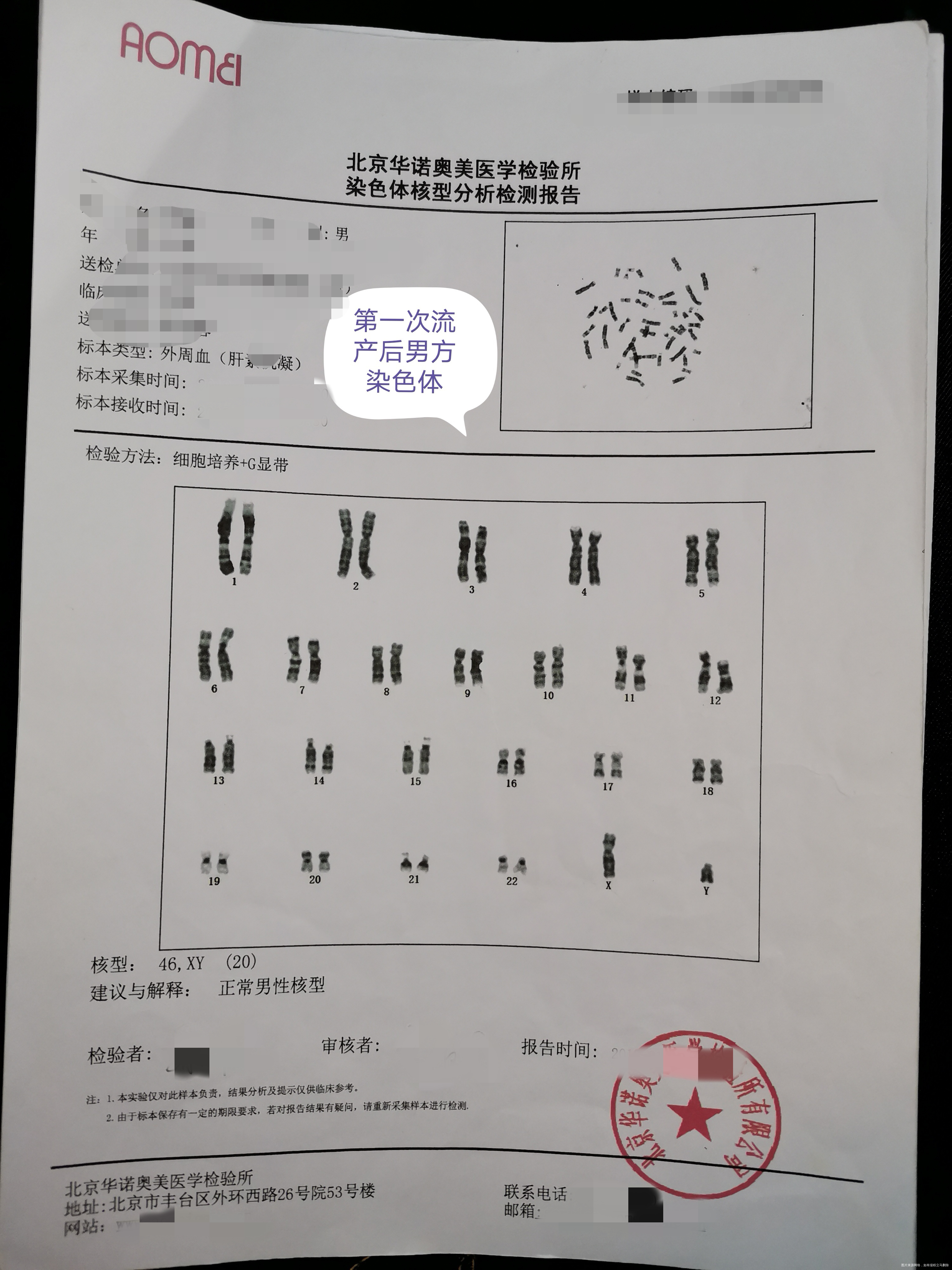 夫妻染色体正常 胚染有问题,45x。一次葡萄