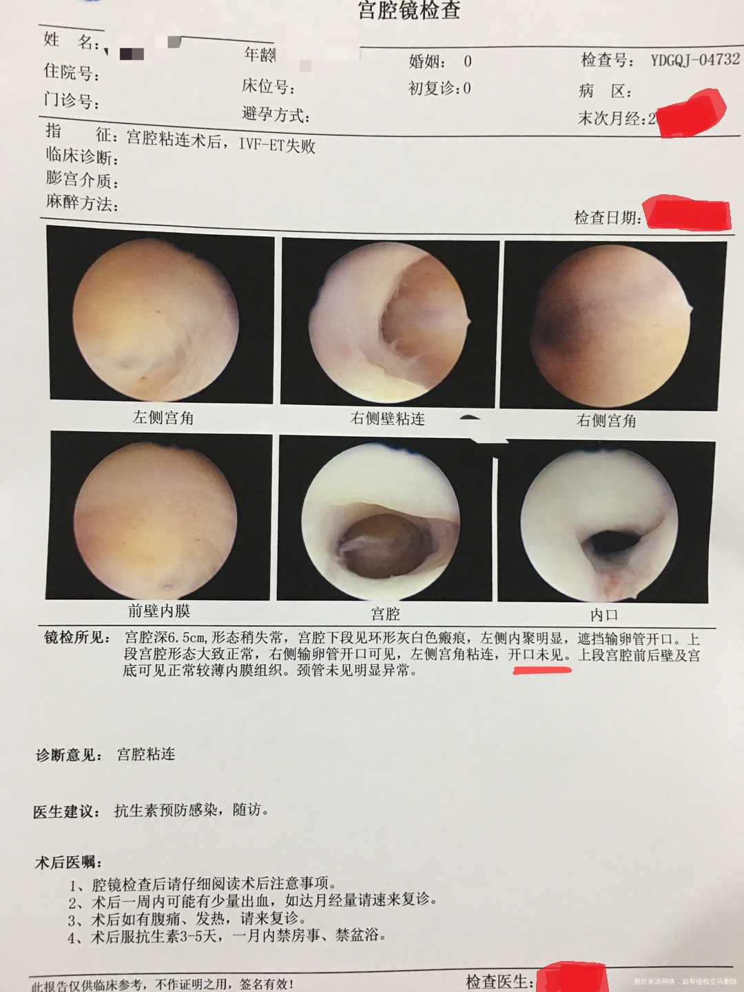 请问我左侧输卵管开口一直不可见,而且自己长封