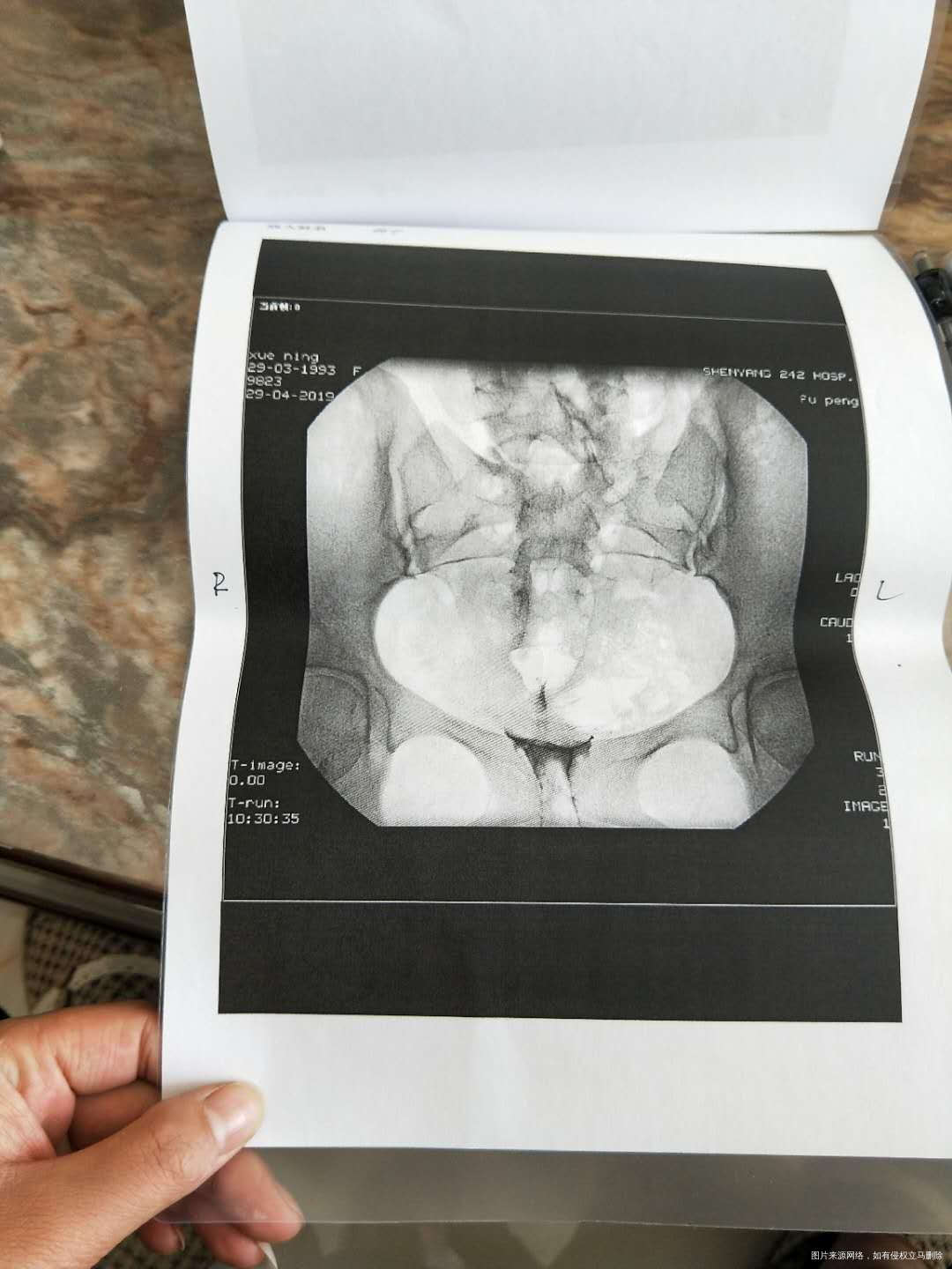 您好，我17年宫外孕左侧输卵管切除了。现在右