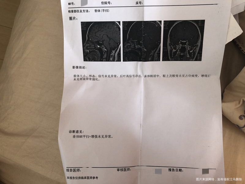 2017年查多囊 现在吃达英和中药。等半年复