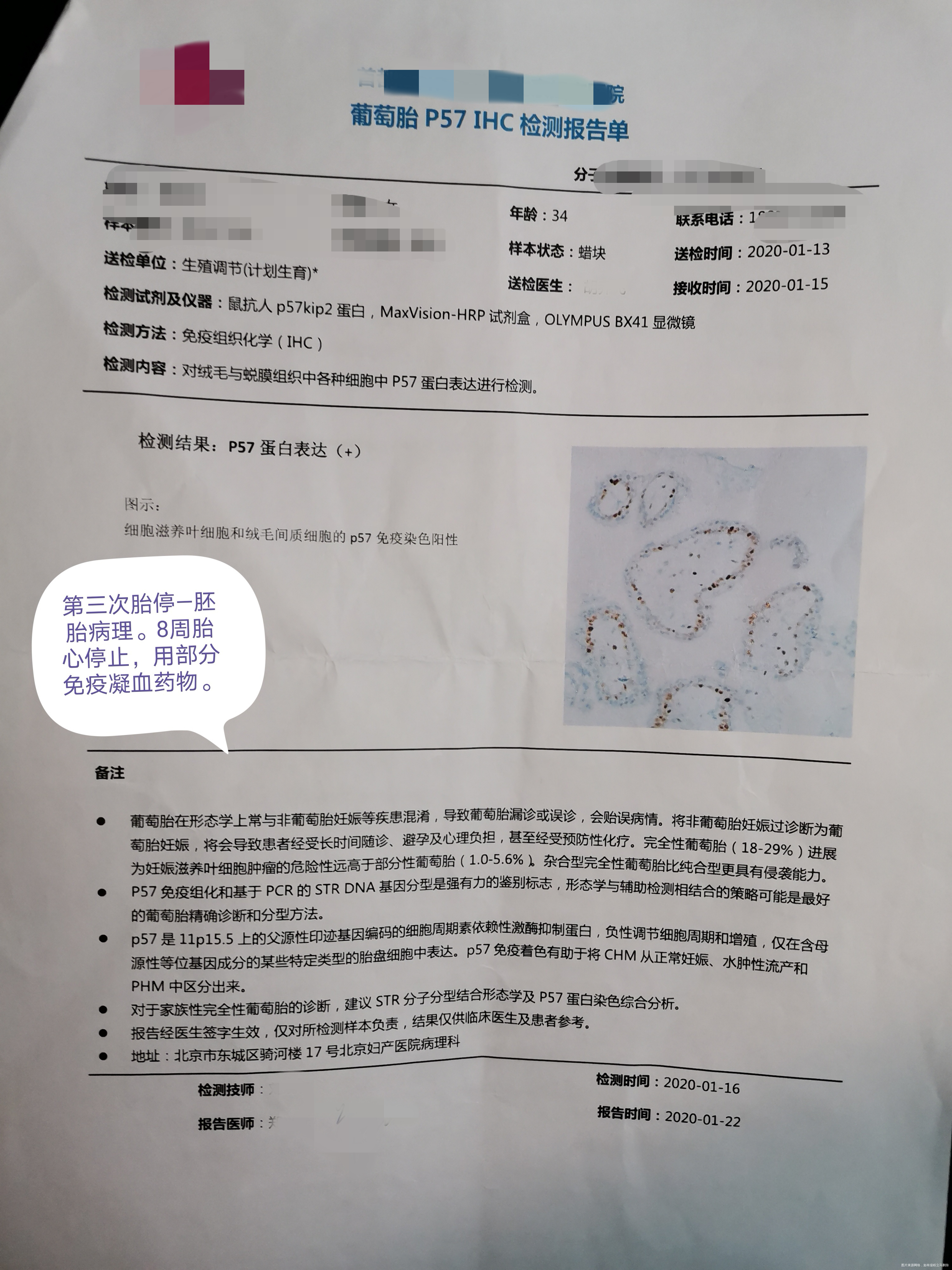 夫妻染色体正常 胚染有问题,45x。一次葡萄