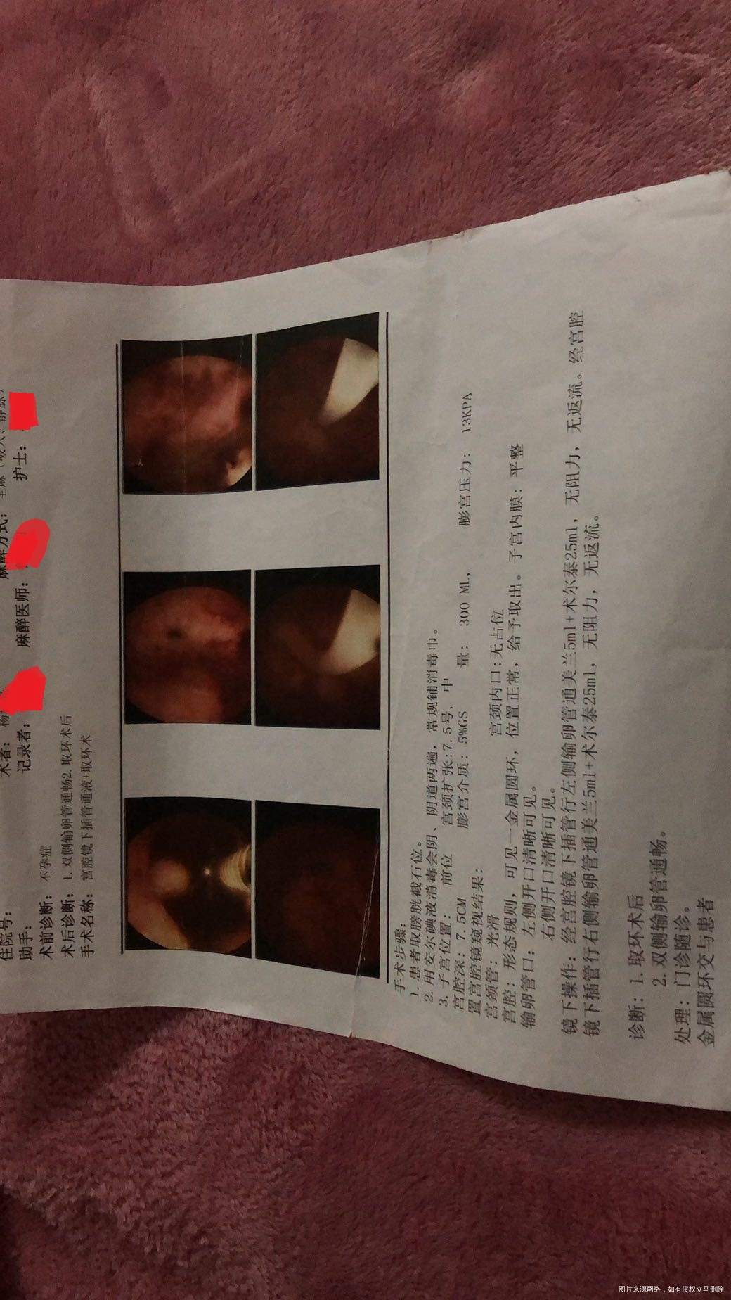 原发性不孕,一开始子宫不全纵隔,月经紊乱,后