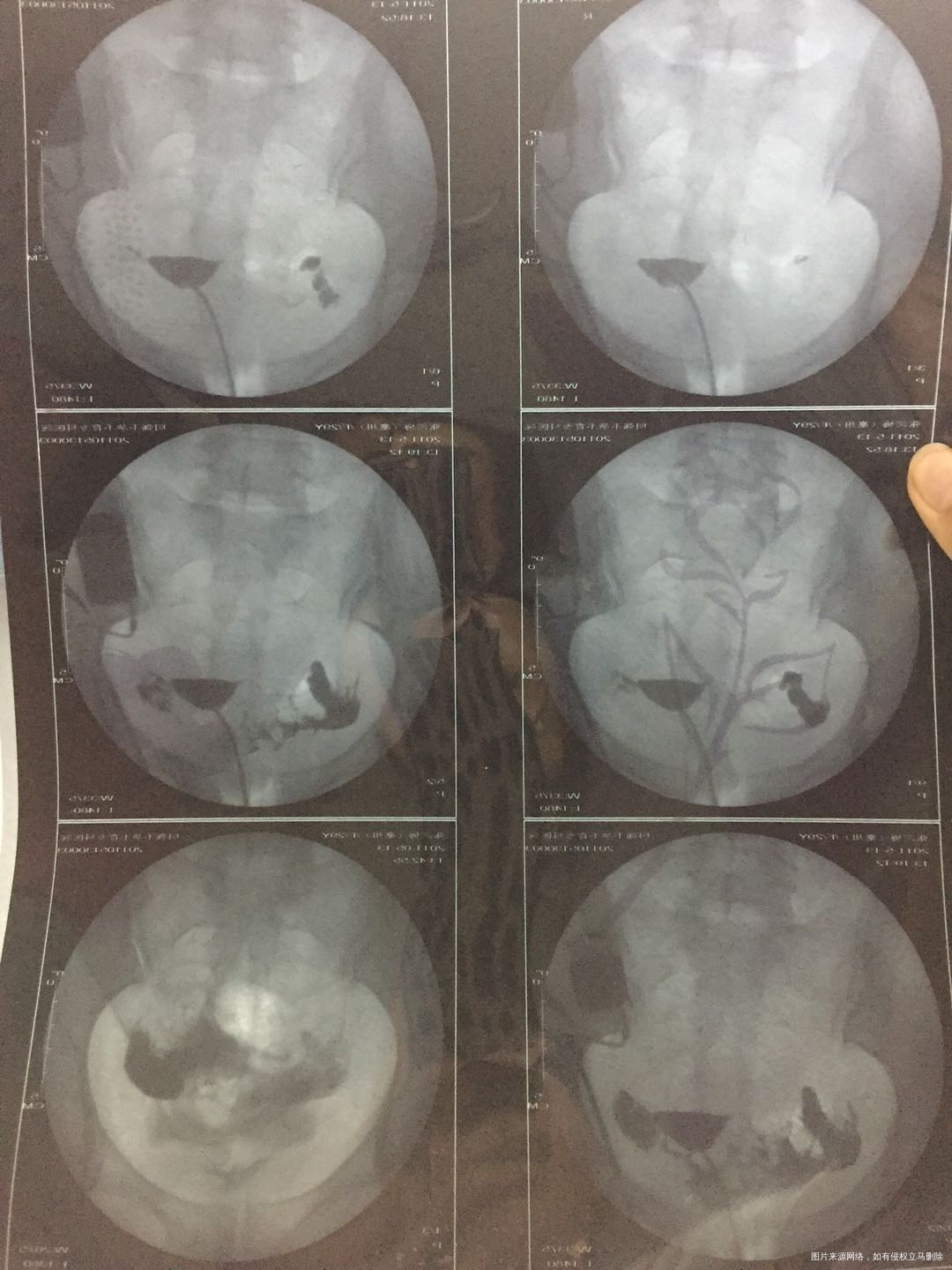 我38了,我的积水,我流产过1次.月经2-4