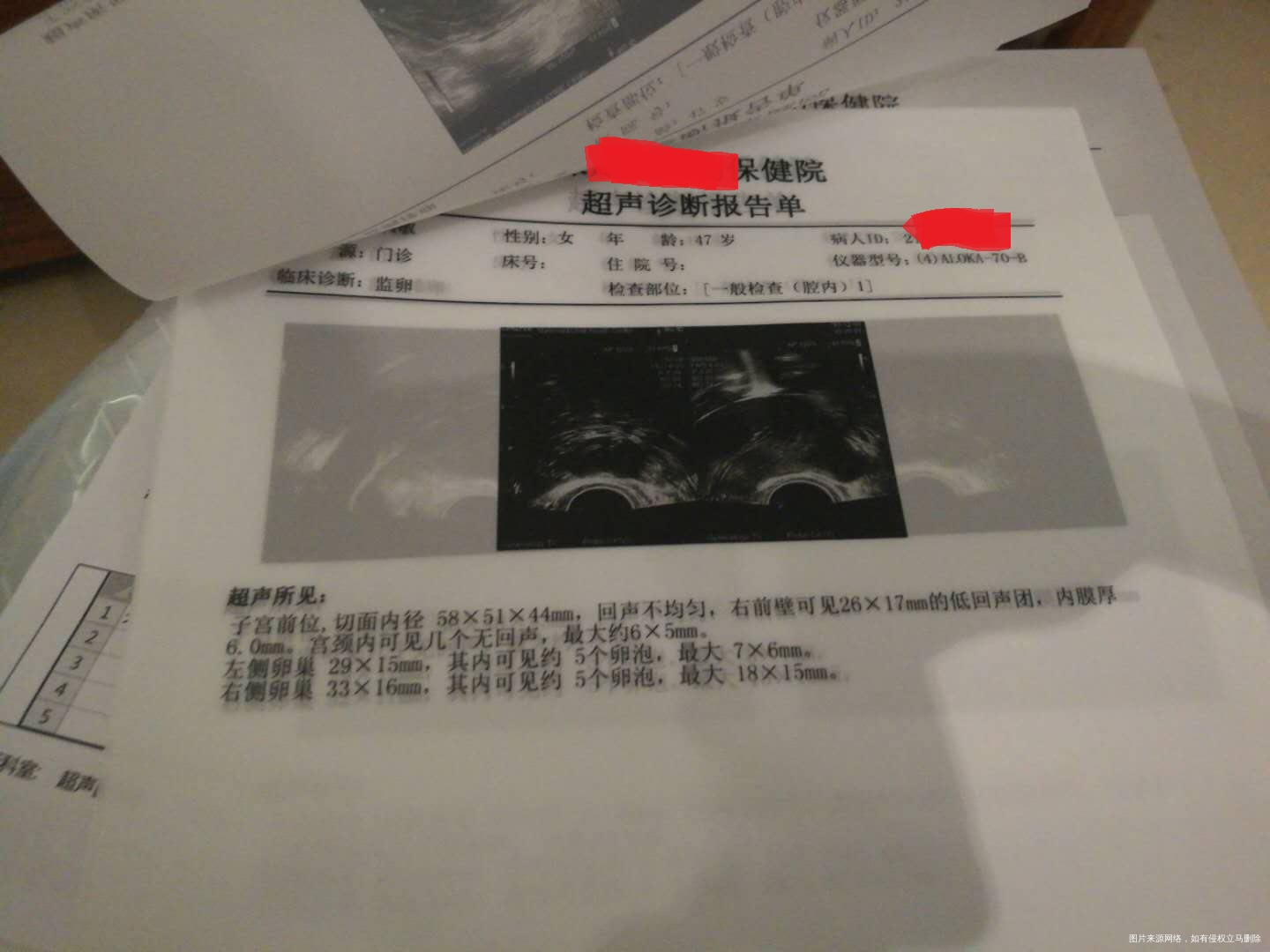 我48岁了,amh0.75,激素六项还好,4