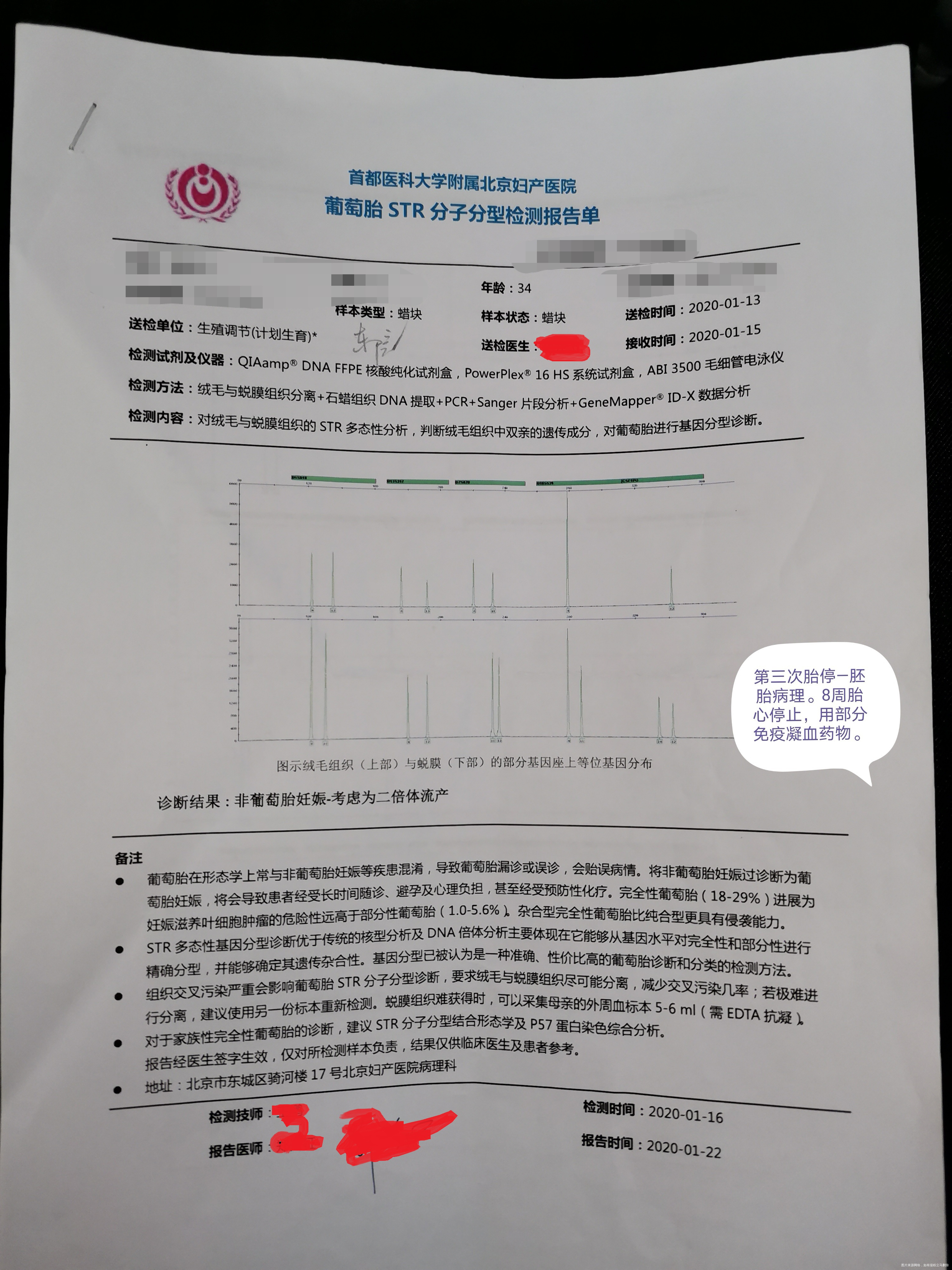 夫妻染色体正常 胚染有问题,45x。一次葡萄