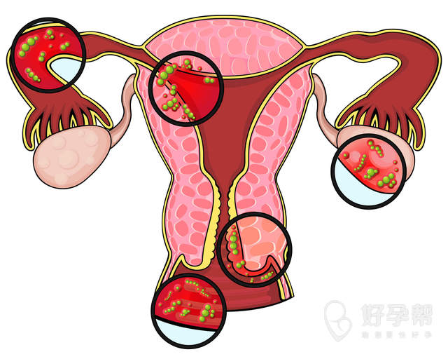 右侧卵巢囊肿严重有可能是怀孕造成的吗？囊肿会对试管婴儿有影响么？