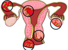 右侧卵巢囊肿严重有可能是怀孕造成的吗？囊肿会对试管婴儿有影响么？