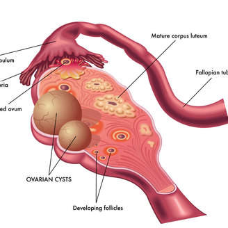 卵巢囊肿用手能摸到吗？卵巢囊肿阴超可以查出来吗？