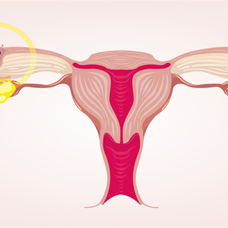 女性子宫腺肌症是什么原因引起的?女性子宫腺肌症能怀孕吗