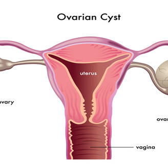 女性多囊卵巢是什么病引起的?还可以怀孕吗?